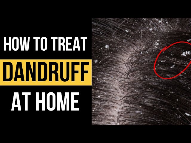 Doctor explains HOW TO TREAT DANDRUFF AT HOME and 5 different anti-dandruff shampoos to use...