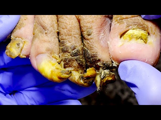 The Old Man's Deformed Nail Has Not Been Cleaned For 5 Years[Dr. Liu's Pedicur]