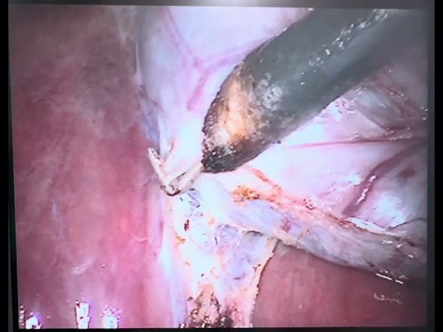 Laparoscopic cholecystectomy unedited 2x with cystic duct clearance