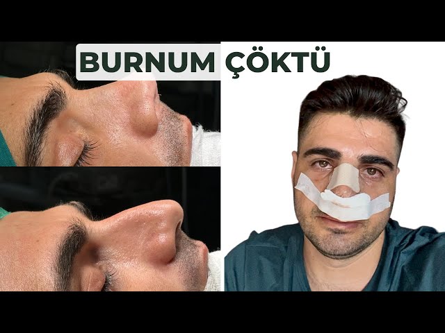 BURUN AMELİYATI SÜRECİM! | 6 AYLIK VLOG | Rüzgar Bilen