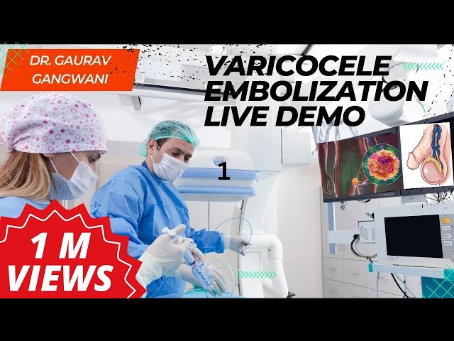 Live Varicocele Embolization Case 1| Non-surgical treatment of Varicocele | Dr. Gaurav Gangwani