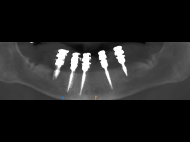 AllOn 5 dental Implant surgery procedure for lower full jaw-best implant Center Chennai India part-1