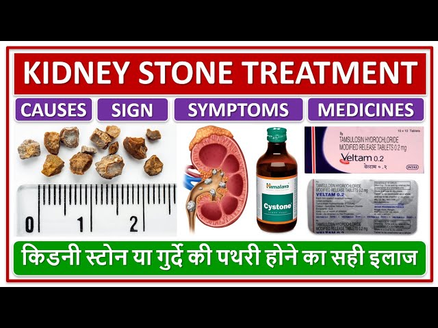 KIDNEY STONE TREATMENT, CAUSES, SYMPTOMS, MEDICINES, किडनी स्टोन या गुर्दे की पथरी होने का सही इलाज