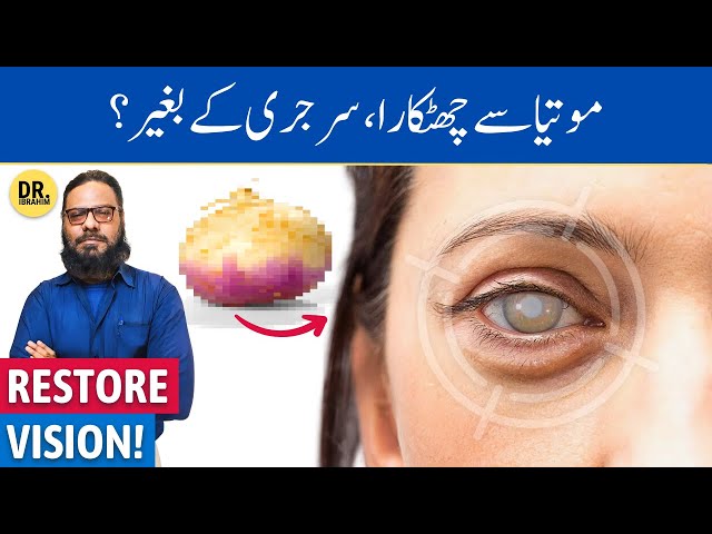 Safed/Kala Motia Ka Ilaj, Bina Surgery! Treating Cataracts Without Surgery | Dr. Ibrahim