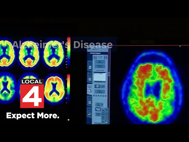 20-year study aims to help prevent brain diseases