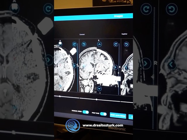 All stages of Deep Brain Stimulation (DBS) Surgery for the treatment of Parkinson’s Disease