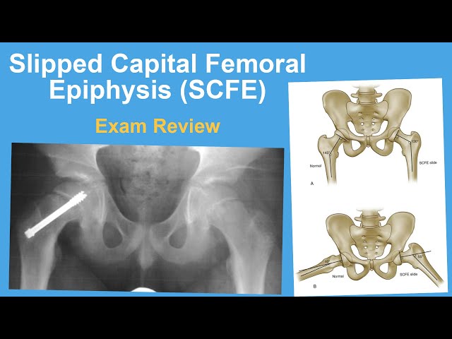 Slipped Capital Femoral Epiphysis Exam Review - Rachel Goldstein, MD