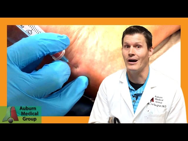 Plantar Fasciitis Injection Treatment for  Heel Pain | Auburn Medical Group