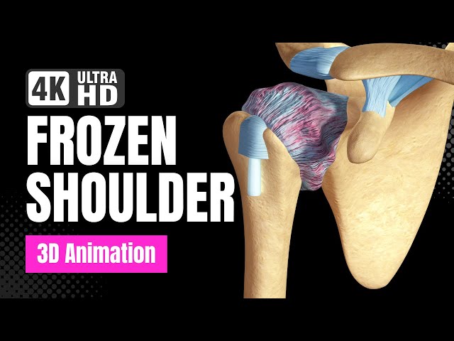 Frozen Shoulder (Adhesive Capsulitis) - 4K 3D Animation