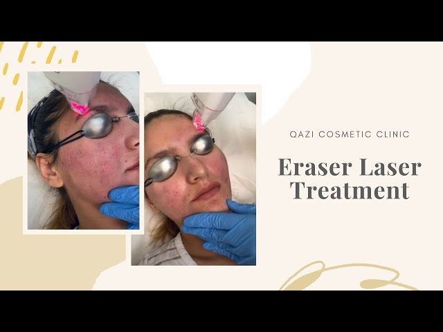 Eraser Laser Treatment | Live with Dr. Nadir Qazi