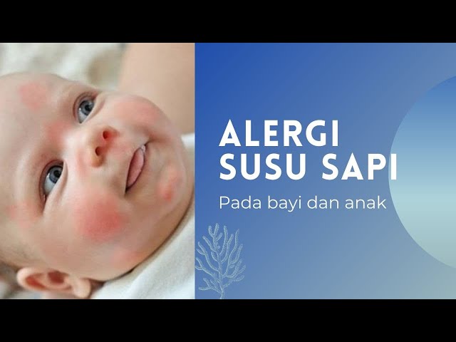 Kenapa Anak saya bisa Alergi Susu Sapi?