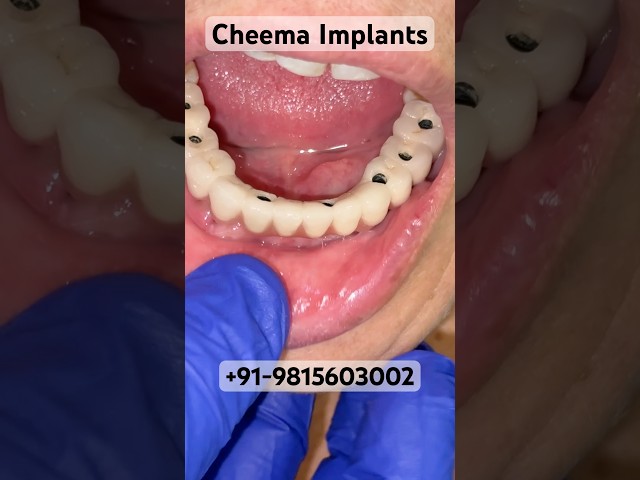 Full Mouth Dental Implants Surgery Procedure screw Teeth procedure Jalandhar Punjab Dentist clinic