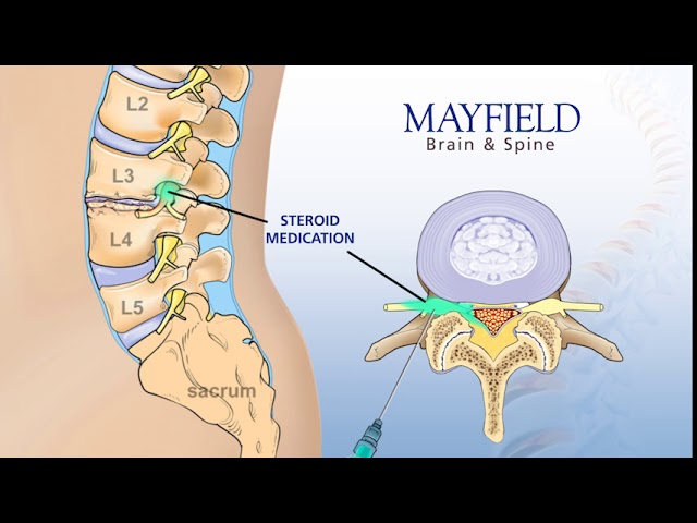 Mayfield Minute: Spinal Stenosis