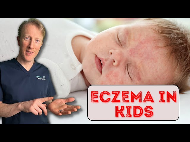 How to treat Eczema in Babies & Children: Dermatology Doctor explains