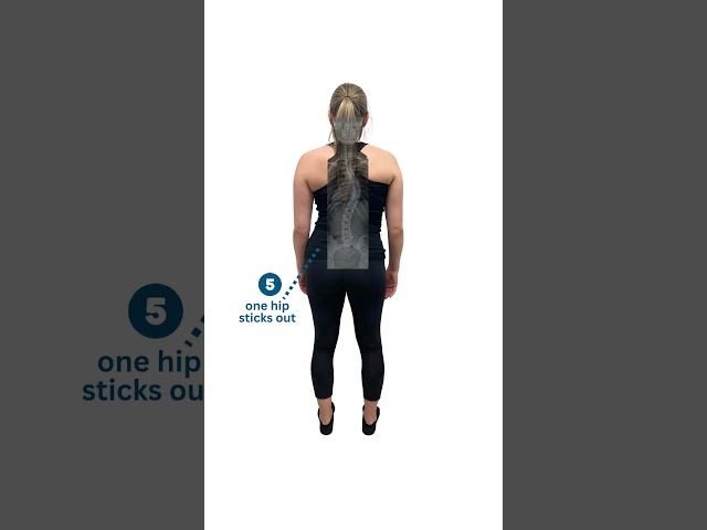 Scoliosis Sign #5: One Hip Sticks Out