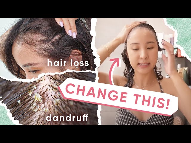 4 Reasons WHY Your Hair Loss & Dandruff ISN’T Getting BETTER + 5 TIPS!