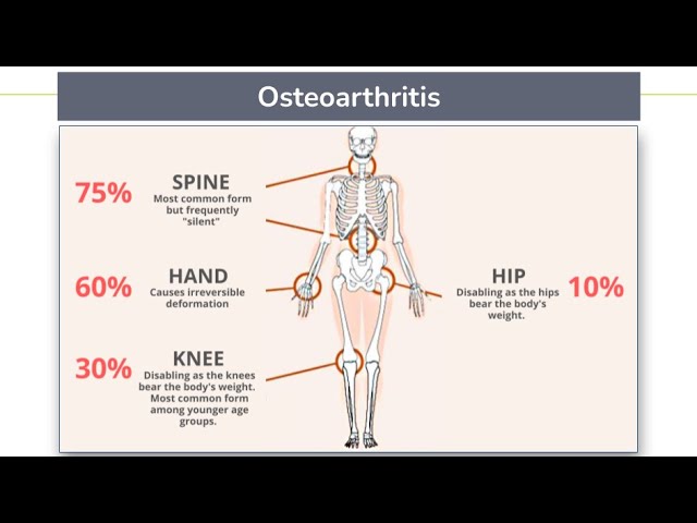 What is Osteoarthritis? Who can it affect? | A Physiotherapist explains | Easthill Physio