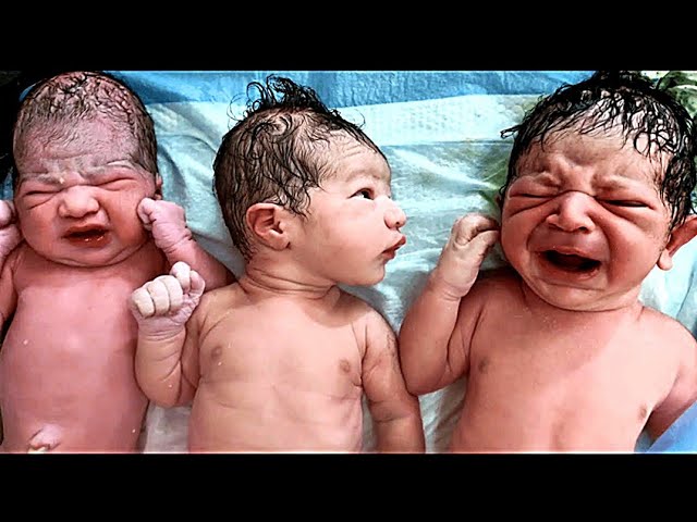 Big size Triplets newborn babies first moments of life.