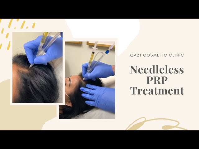 Needleless PRP Treatment for Hair Loss | Live with Dr. Nadir Qazi