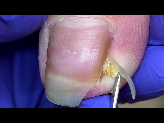 Rare super long nails, how long has it been since they were cut?【Doctor Liu Pedicure】