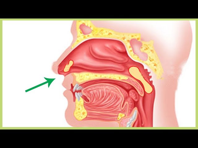 Waspada Terkena Sinusitis ! Begini Cara Mengobati Sinusitis Akut !