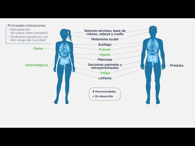 Para qué tumores está indicada la protonterapia. CUN