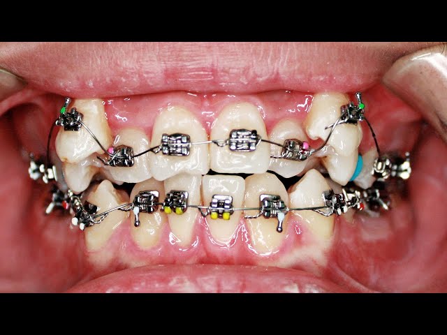 NIỀNG RĂNG LÒI SỈ NHƯ THẾ NÀO? #orthodontist