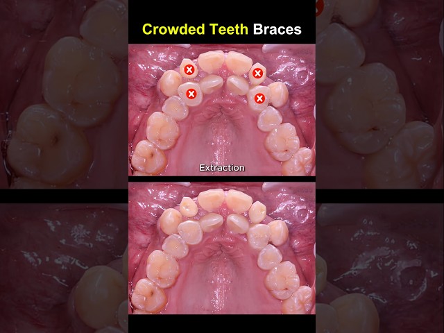 Complex braces for crowded teeth #braces #orthodontist #dentist