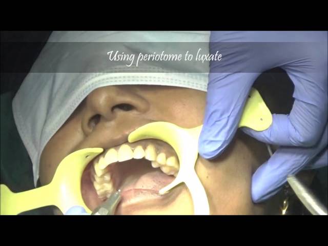 Upper canine -IMMEDIATE EXTRACTION AND IMMEDIATE IMPLANT SURGERY