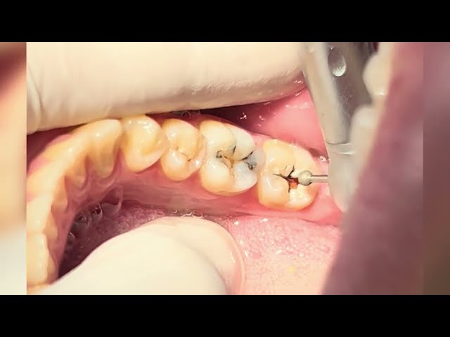 Teeth Composite Restoration After Deep Caries Cleaning