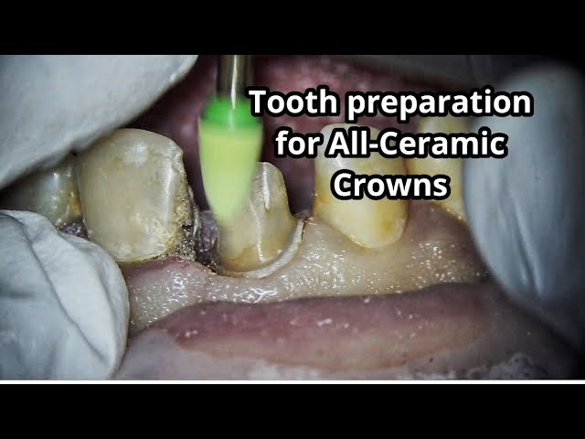 Tooth preparation for All-Ceramic Crowns #teeth #dentist #dental #dentistry #cavity #caries #decay