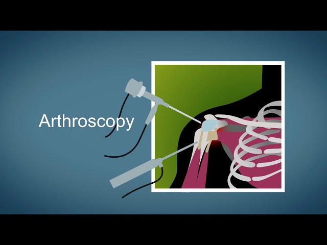 Positioning in arthroscopic anterior shoulder stabilization: Does it matter?