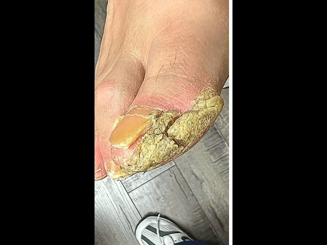 Removing THICK, CRUSTY CALLUSES! #shorts #shortsvideo #shortsviral