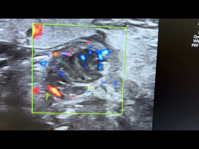 Ultrasound of normal tonsil