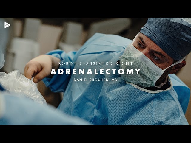 Robotic Right Adrenalectomy by Daniel Shouhed, MD | Preview