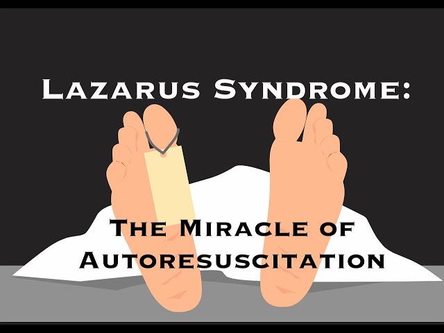 Died and Came Back!  Lazarus syndrome: The Miracle of Autoresuscitation