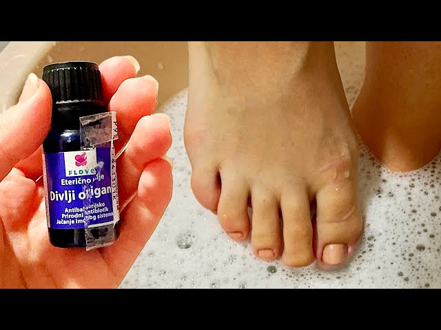 If I died I wouldn't know - NAIL FUNGUS disappears immediately! ( NATURAL SOLUTION )