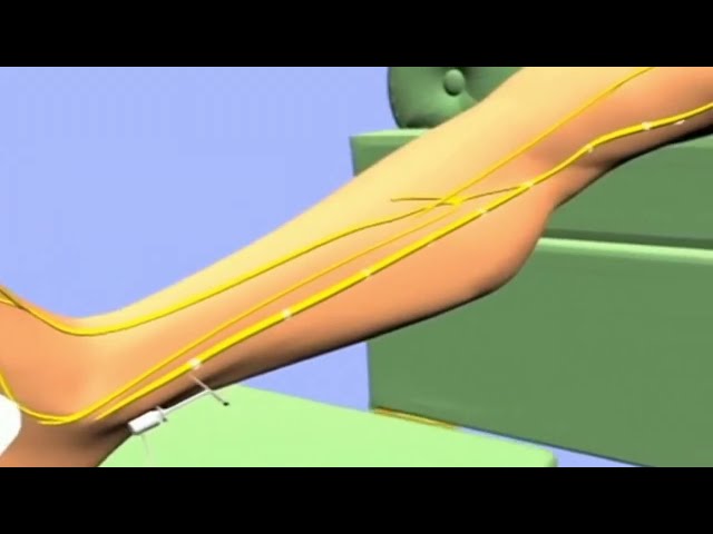 Here's how percutaneous tibial nerve stimulation (PTNS) provides relief from overactive bladder