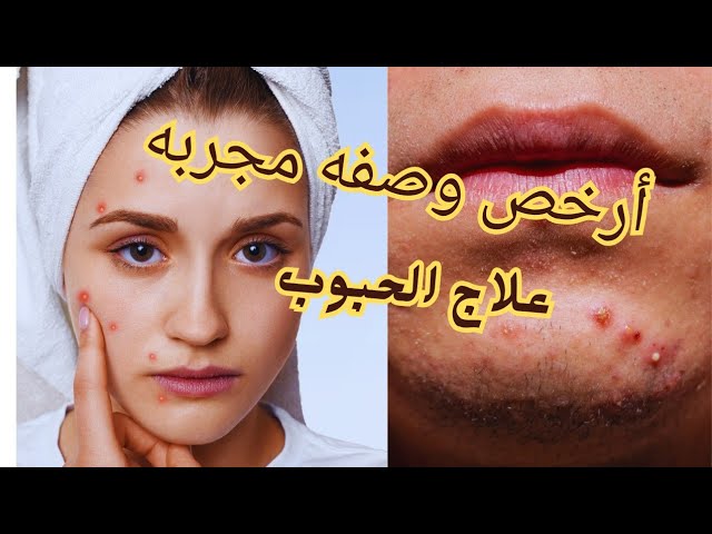 How to treat pimples and acne scars, freshness, lightening and peeling