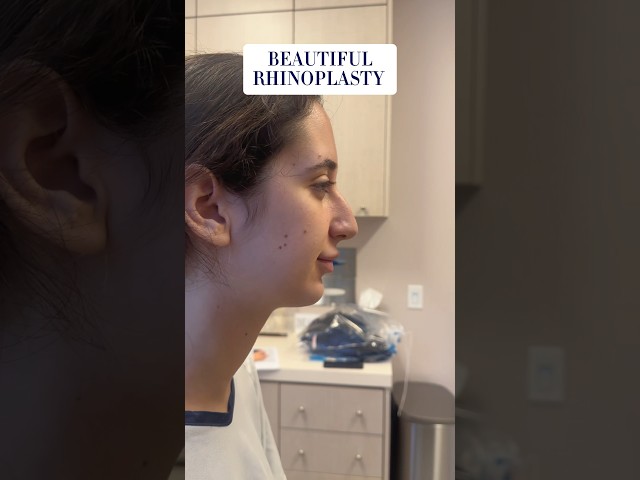 18 Year Old Rhinoplasty Patient - Beautifully Natural Results