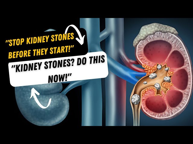 Kidney Stones: Causes, Symptoms & How to Prevent Them!