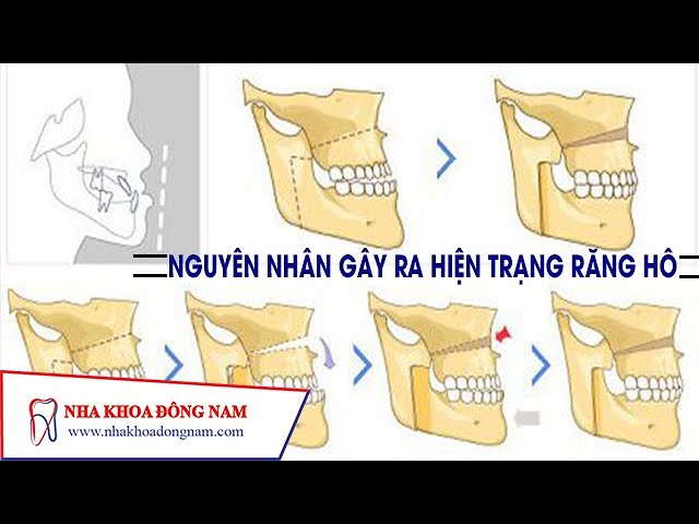 Nguyên Nhân Gây Ra Hiện Trạng Răng Hô | NHA KHOA ĐÔNG NAM®