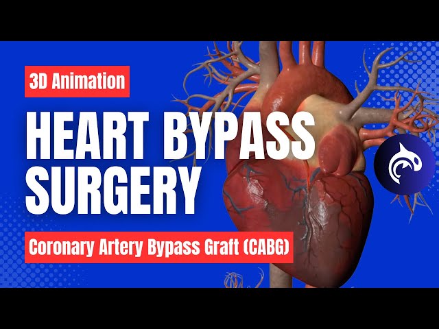 How Heart Bypass Surgery Works (Coronary Artery Bypass Graft CABG) - 3D Animation