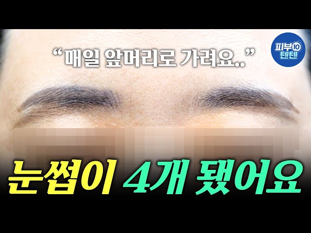 [Eng] Eyebrows Making You Look Older? 😢😢 3 Dermatologist-Approved Fixes!