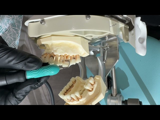 Using the Ultrasonic (Cavitron) On Dental Root Surface