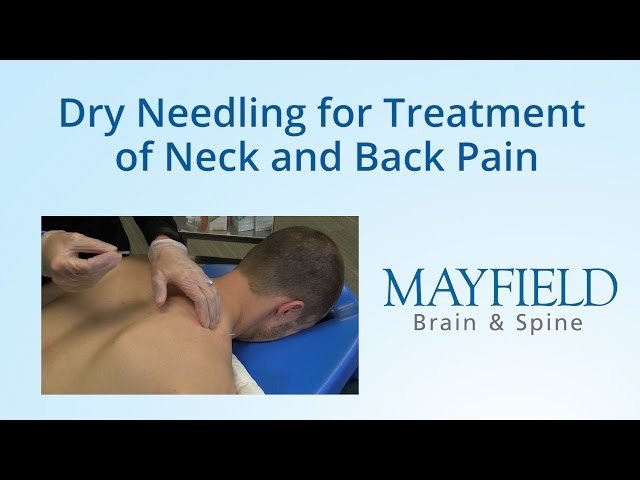 Dry Needling for Treatment of Neck and Back Pain