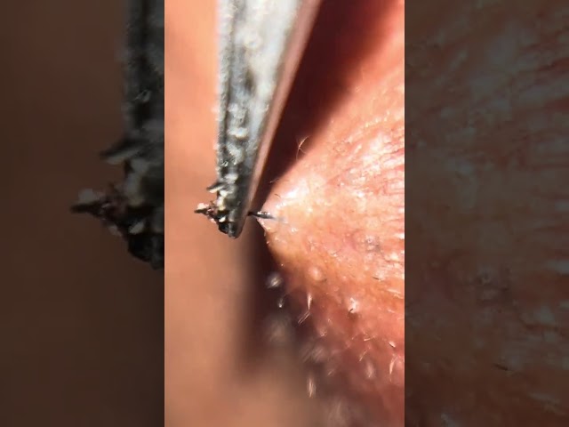 ingrown hair plucking / tweezing chin ASMR