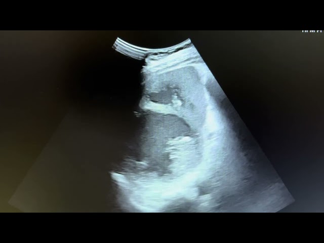 Ultrasound of Left kidney pyelonephritis + splenic abscess in 50 yr diabetic patient.