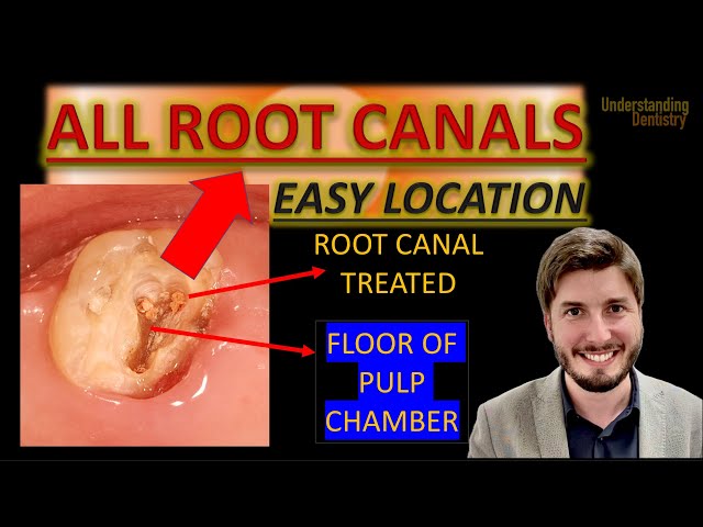 How to FIND THEM? Teeth After Root Canal Treatment Video (Dental Anatomy Lecture & Endodontics)