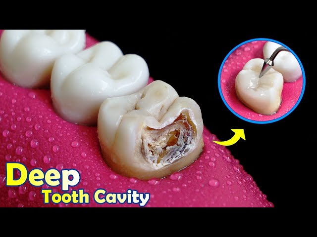 FANTASTIC Restoration Of Tooth Cavity By Root Canal And Composite Filling